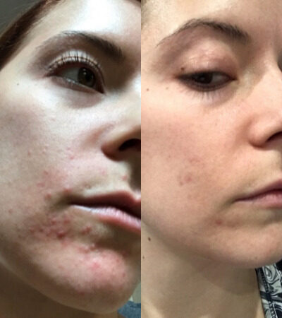 Perioral dermatits before after